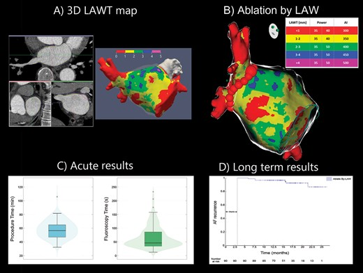 Ablazione della fibrillazione atriale guidata dallo spessore di parete: mappa 3D LAWT, tabella di modulazione dell'energia (Ablation Index), tempi di procedura e fluoroscopia e risultati a lungo termine sull'assenza di recidive